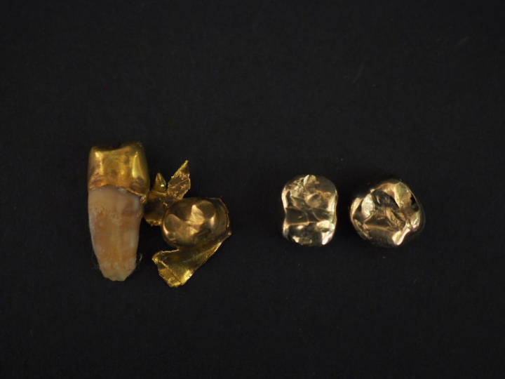 Ensemble comprenant de l'or dentaire en or jaune 750 et en or jaune 58