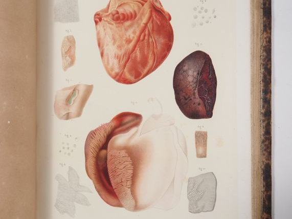 [MÉDECINE]. LEBERT (Hermann). TRAITÉ D’ANATOMIE PATHOLOGIQUE GÉNÉRALE 