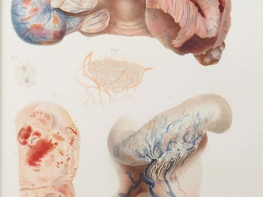 [MÉDECINE]. LEBERT (Hermann). TRAITÉ D’ANATOMIE PATHOLOGIQUE GÉNÉRALE 